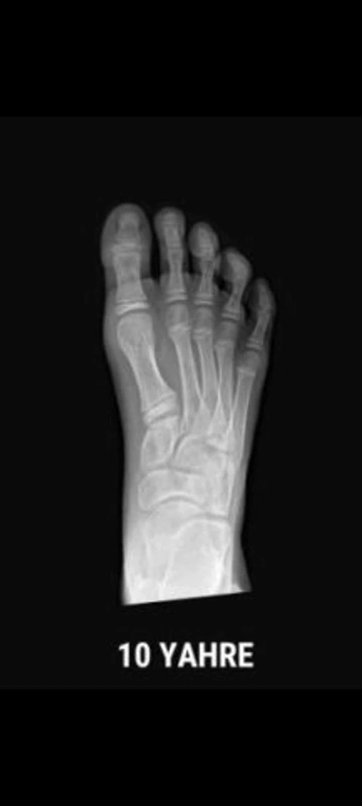 Radiografía del pie infantil a los 10 años que muestra la estructura ósea y el desarrollo natural del pie sin restricciones.