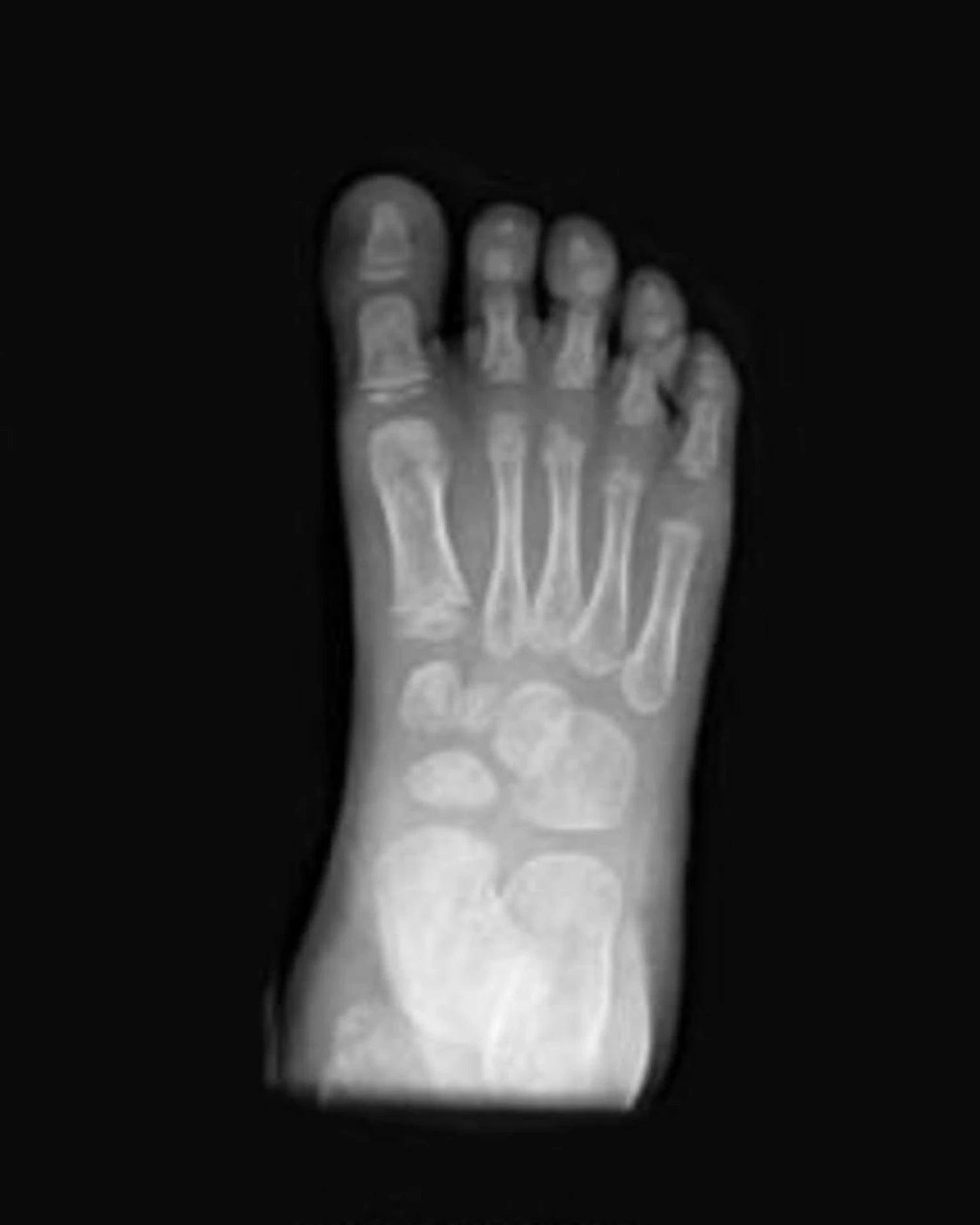 Radiografía del pie de un niño de 3 años que muestra el desarrollo óseo infantil en una etapa temprana del crecimiento.